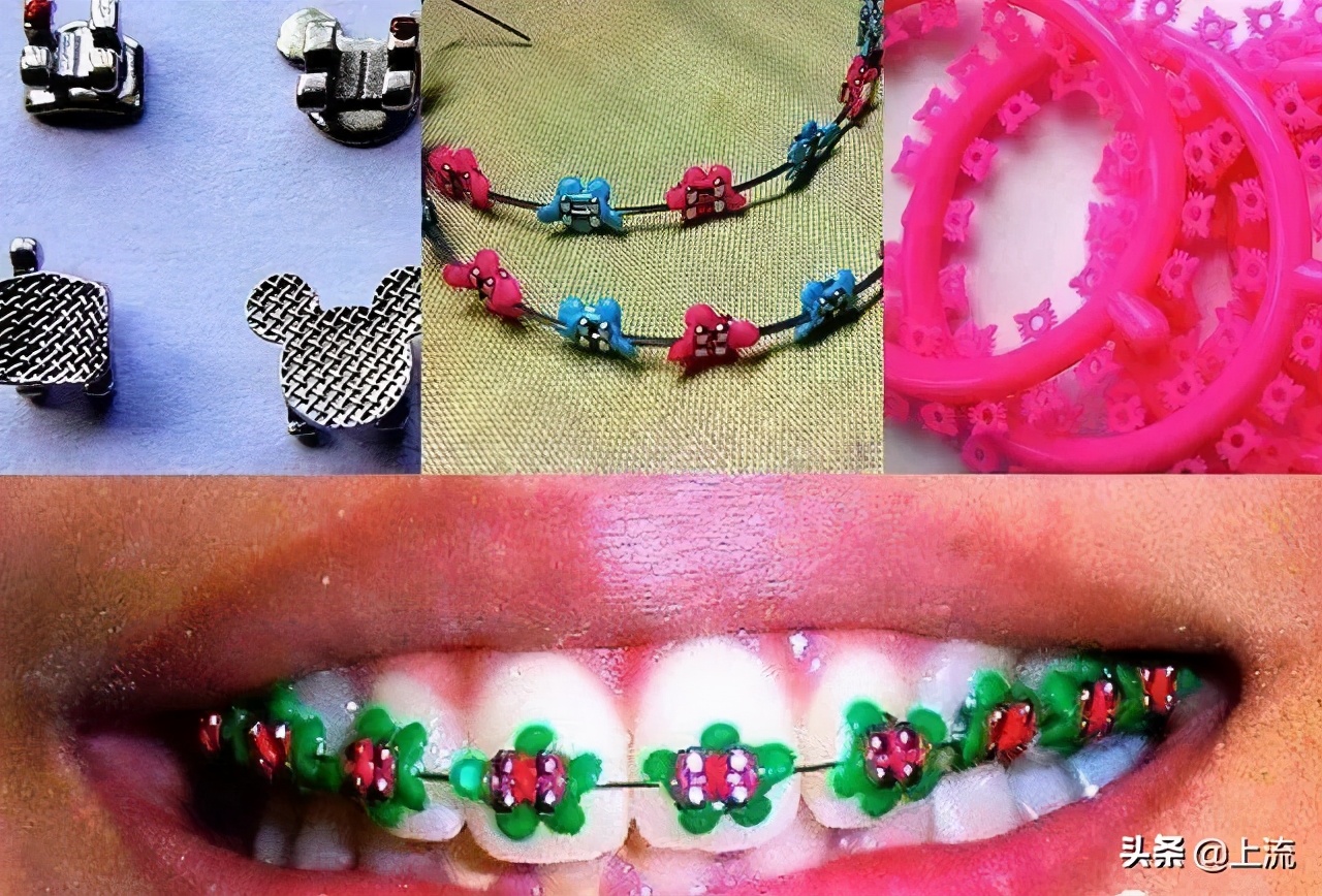 泰国流行戴牙套,泰国最近很火的牙套