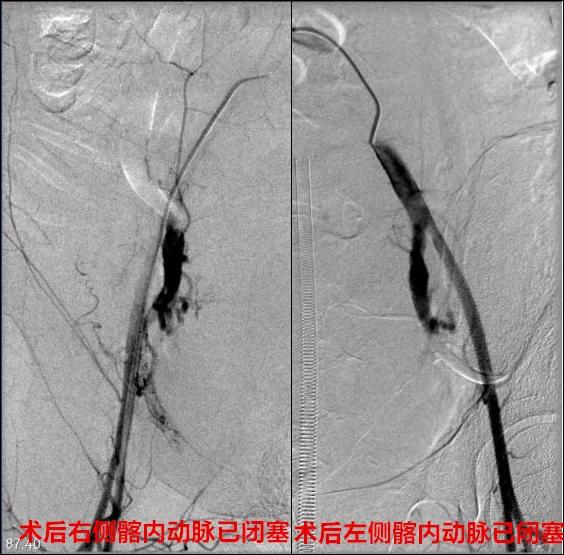 一产妇手术台上大出血死亡,一产妇大出血急需血小板去世