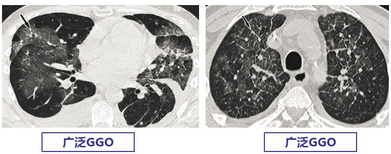专家讲新冠二次感染的情况讲解,感染新冠专家怎么说