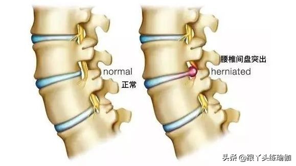 瑜伽腰椎病锻炼方法,腰椎病可以练习瑜伽吗