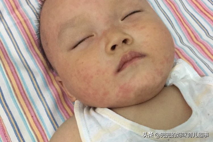1岁宝宝发烧三天后出现红疹子,1岁宝宝发烧后身上起红疹怎么办