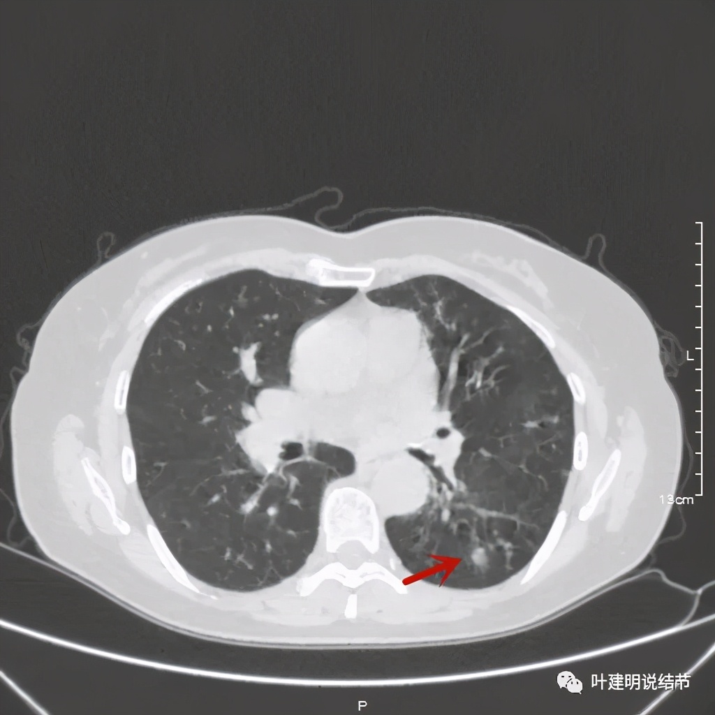 这样的实性结节伴小空洞会是肺癌吗?
