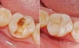 蛀牙总是一颗接着一颗？看来你不只是需要补牙了