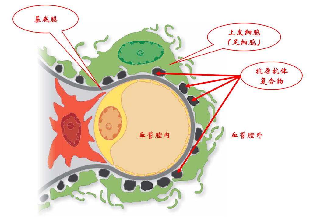 膜性肾病流行病学,膜性肾病的最新研究