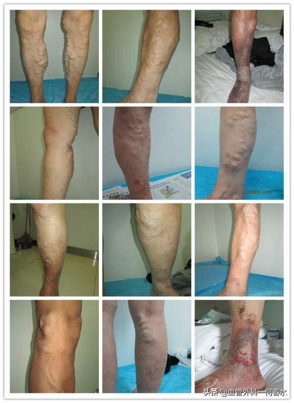 轻微静脉曲张可以靠锻炼恢复吗,静脉曲张术后康复锻炼