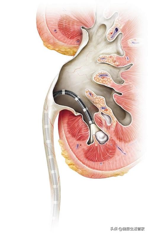 尿路结石疼痛一招搞定是真的吗,得了泌尿系结石怎么办科普视频