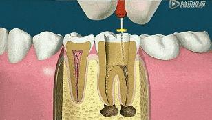 小洞不补大洞受苦早发现早治疗,为什么说牙齿小洞不补大洞吃苦