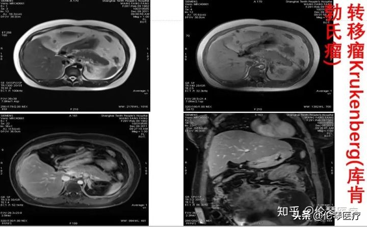 卵巢肿瘤核磁共振能看出来吗,超声测出来肿瘤