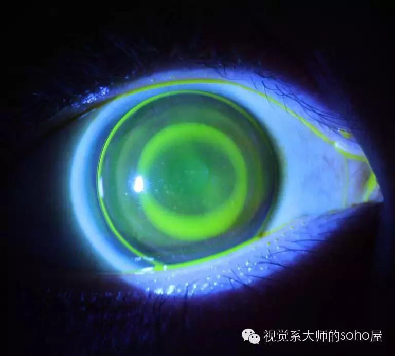 如何选择角膜塑形镜的品牌,怎么选角膜塑形镜的参数