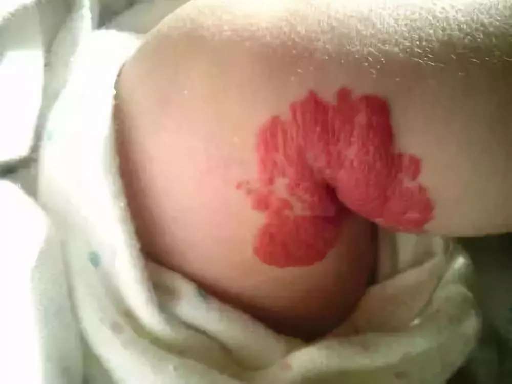 宝宝身上胎记很多是怎么回事,宝宝身上胎记多是什么原因引起的