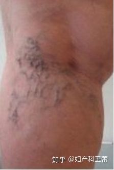 孕晚期36周后注意事项,孕晚期胎儿缺氧怎么注意