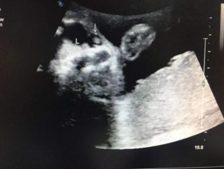 胎儿左右眼内侧无回声鼻泪管囊肿,胎儿鼻泪管囊肿超声诊断