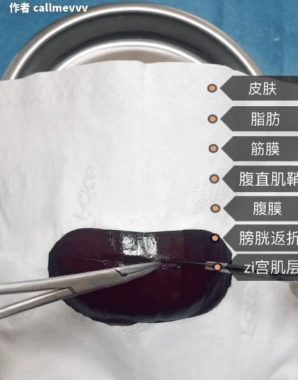 香蕉割包皮,洋葱剖腹产?这是我见过最秀的医生