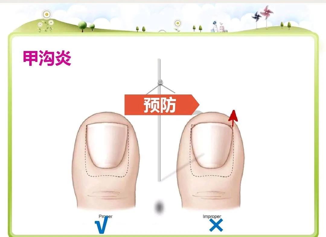 儿童怎么预防甲沟炎,美甲能预防甲沟炎吗