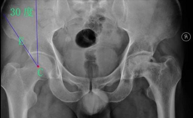 什么是成人髋关节发育不良,成人髋关节发育不良贴吧