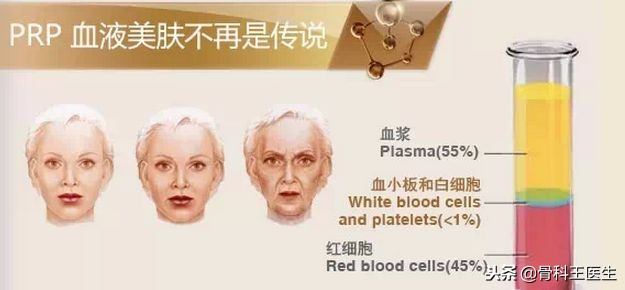 指南推荐！关节炎新疗法，PRP到底是何方神圣？