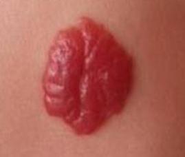 百天宝宝患有血管瘤，激光、敷药该如何抉择？愁坏妈妈