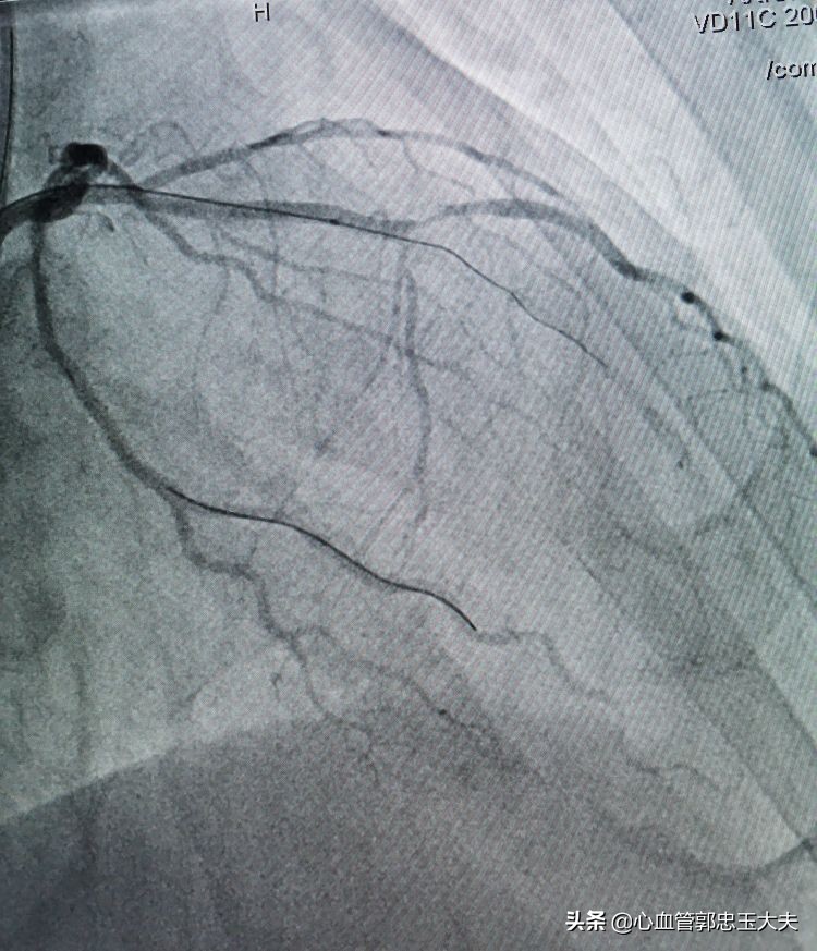 CTO遇到钙化病变怎样才能把血管打通？