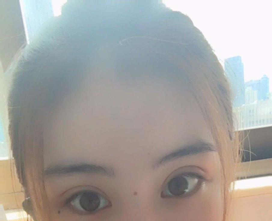 双眼皮修复内宽改窄真实案例,双眼皮修复宽改窄后期案例