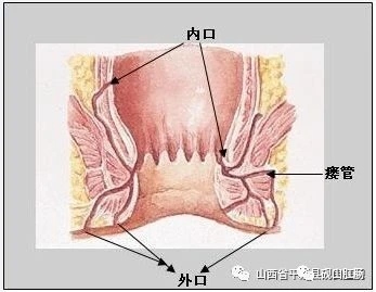 肛瘘难受吗?发现肛瘘怎么办?