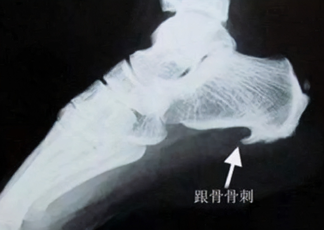 骨刺是引起疼痛的主要原因,骨刺跟骨质增生是一个病吗