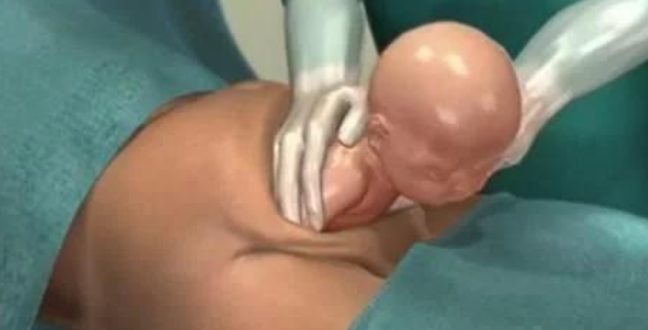 一分钟了解剖宫产视频,30秒了解剖宫产