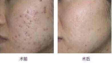 鍋氱編瀹瑰幓姣涘瓟绮夊埡榛戝ご鐥涘悧,鍋氱編瀹圭鐥樺潙