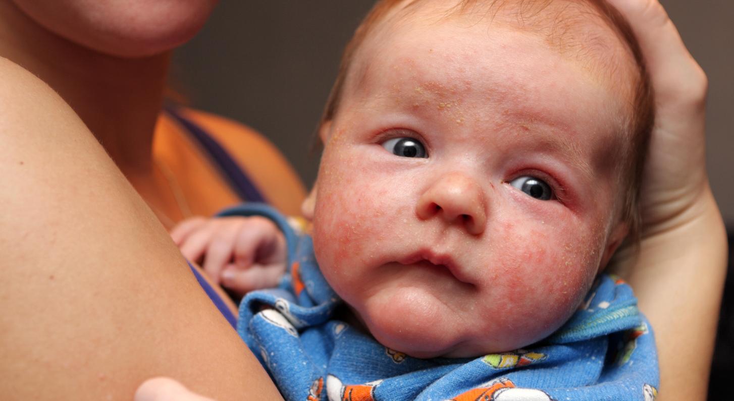 婴儿湿疹可以擦激素的药膏么,婴儿湿疹可以用激素膏吗