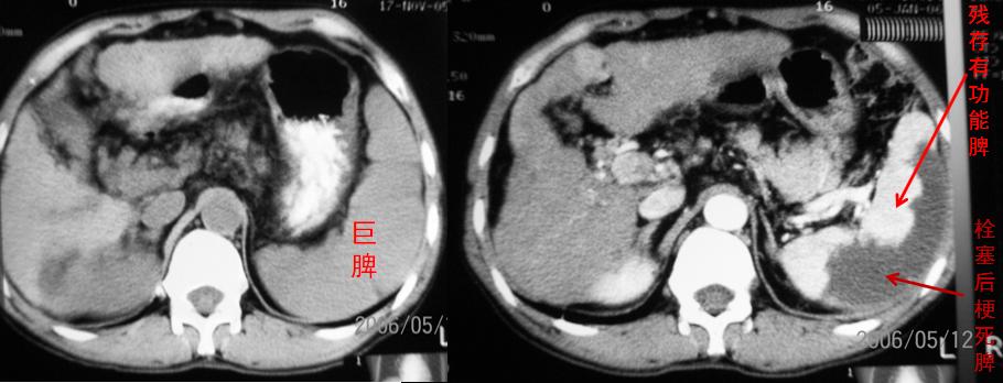 引起脾亢的原因,脾亢一定要切除吗