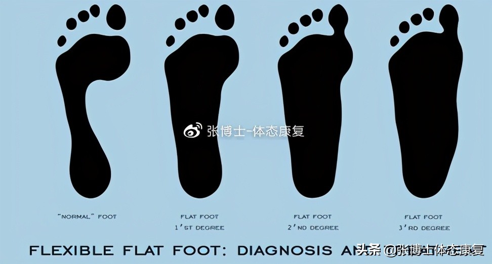 体态畸形怎么矫正,体态矫正腿型修复前景怎样