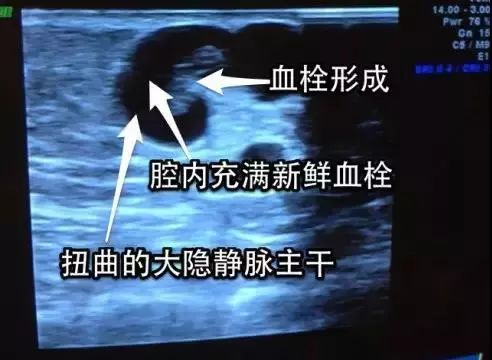 下肢静脉曲张血栓性静脉炎的症状,静脉曲张怎么会引起血栓性静脉炎