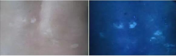 喝酒导致白癜风扩散,喝酒导致白癜风严重