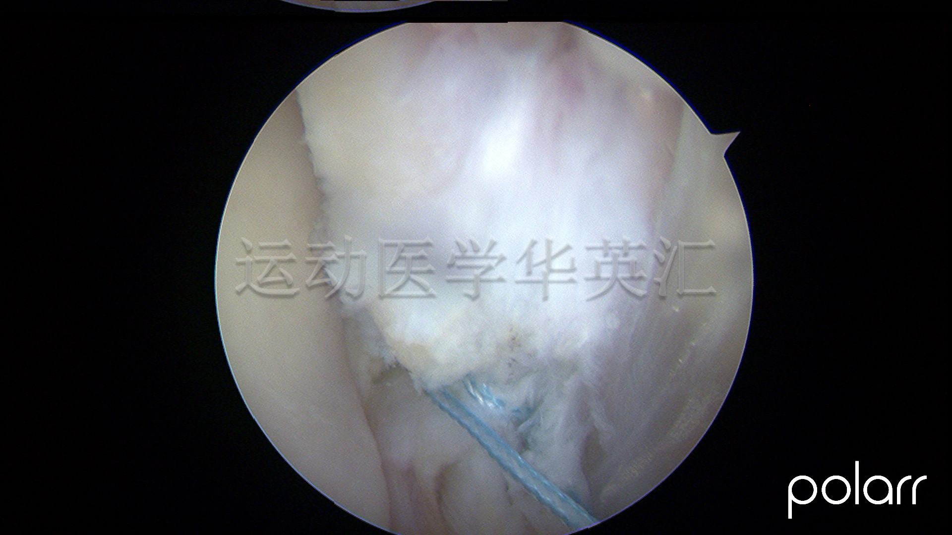 脚踝三角韧带损伤导致脚踝不稳,足踝关节内侧三角韧带损伤