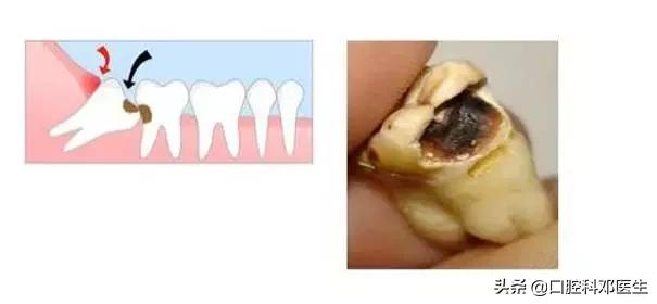 智齿很小一个自己就拔掉了,稍微晃动的智齿拔掉很快吗