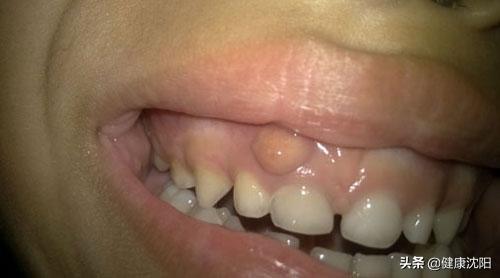 牙龈起包在家怎么办,牙龈有个脓包会传染吗