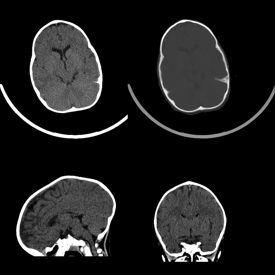 先天性颅脑发育不全,先天颅脑发育不良能治吗
