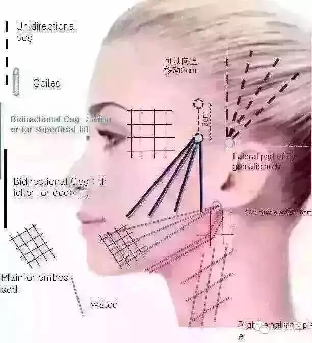 什么是线雕美容过程,什么是线雕眉