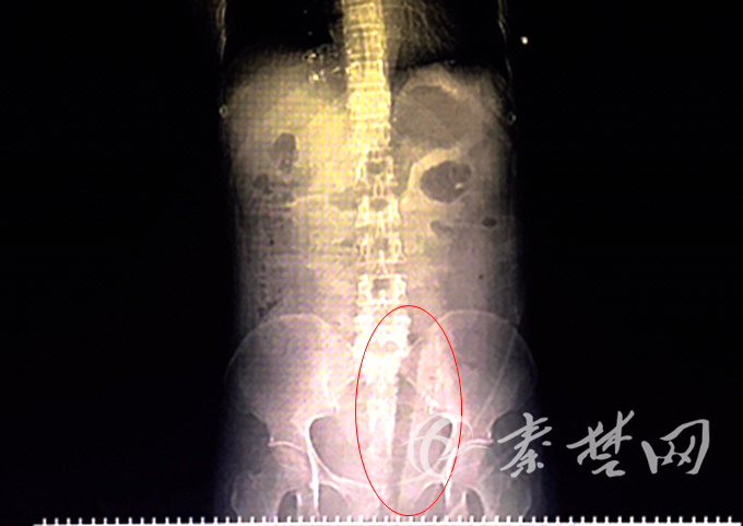 十堰一女子摘樱桃时跌落30厘米长断枝插进下身直至腹腔！