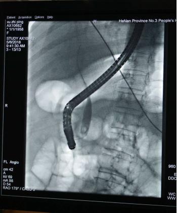 肝内胆管结石怎么治疗,肝胆管结石中医治疗