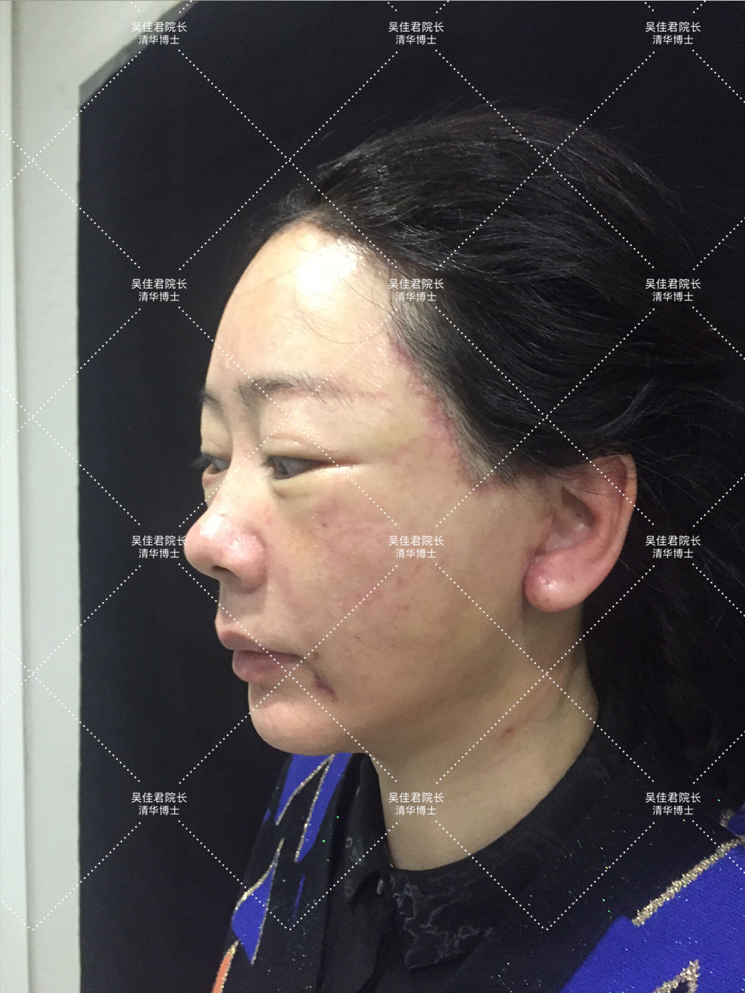 拉皮手术会加速衰老吗亲身经历,40多岁做小拉皮术后6个月