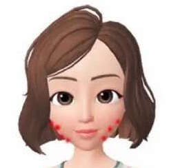 鼻翼两侧和下巴长痘什么原因引起,脸颊两边长痘是什么原因该怎么办