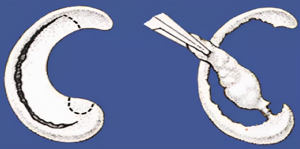 关节镜的适应症是什么,关节镜操作流程及注意事项