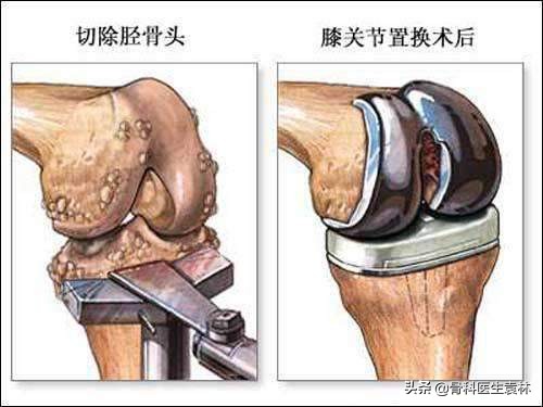 膝盖长骨刺变形用什么方法能治好,膝盖长骨刺怎样治疗才能根治