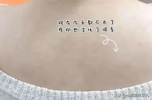 床单久睡不晒螨虫“成堆”?教你1招,不用洗不用晒,轻松除螨虫