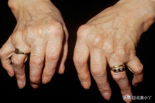 关于治疗类风湿关节炎的讲座视频,如何用药可以延缓类风湿关节炎