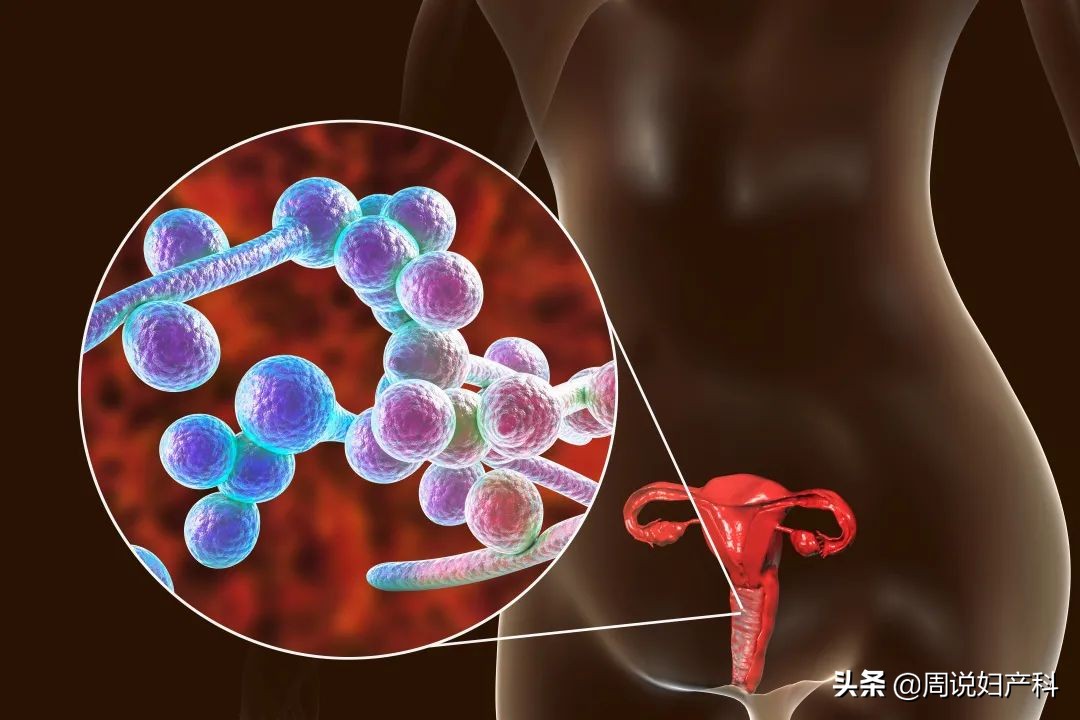 女生得阴道炎跟不自爱没关系,而是跟这3点有关系