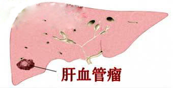 结节不用做手术,吃药就能好?这些情况需要注意