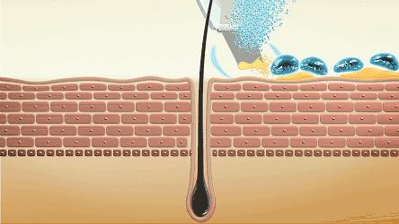 切眼袋会加速衰老的案例,割双眼皮衰老更快