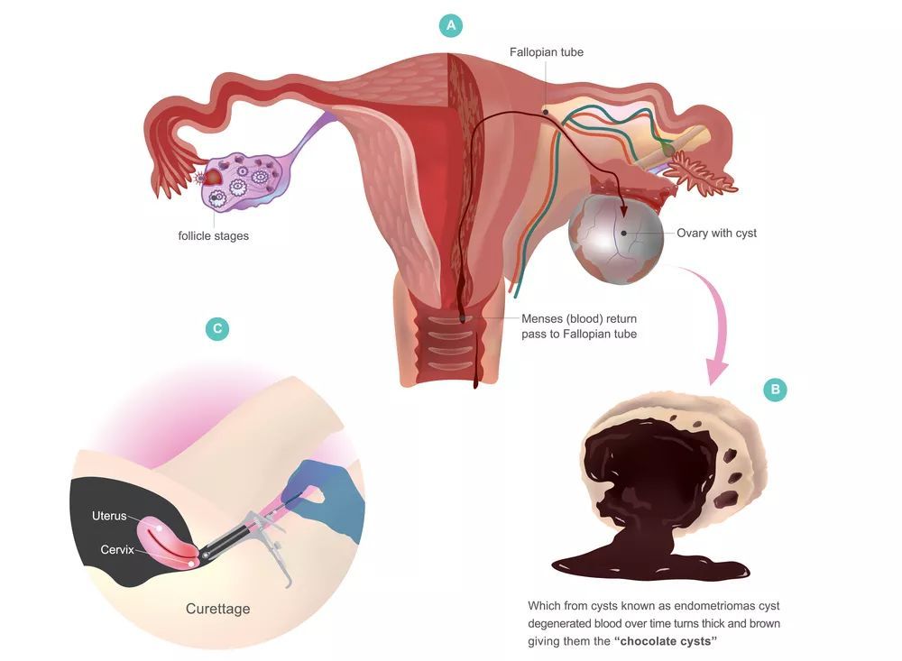 青春期少女巧克力囊肿,年轻女性巧克力囊肿