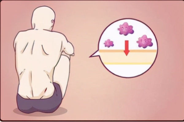 6型尖锐性湿疣,关于尖锐性湿疣正确说法